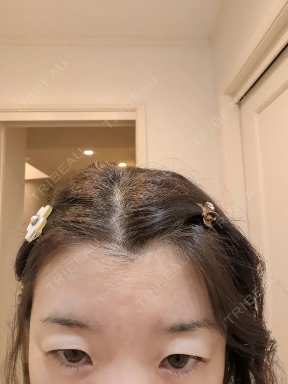 再生医療 A CLINIC（エークリニック） 新宿院 BEFORE メイン用