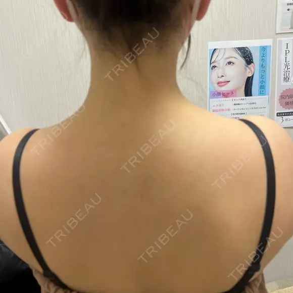 ボトックス（肩） ちぐさ内科クリニック 覚王山 BEFORE メイン用