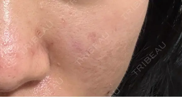 ダーマペン 大美会クリニック 京都烏丸院 BEFORE メイン用