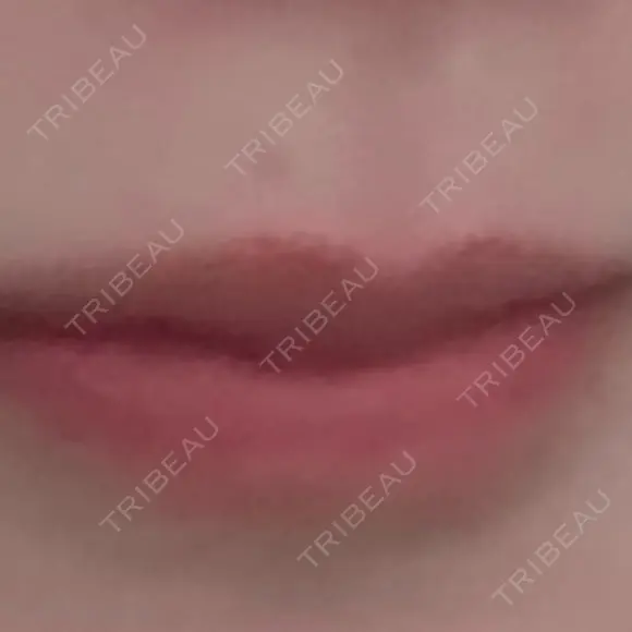 ヒアルロン酸注入（唇） / ボトックス（口角） ルラ美容クリニック 大阪本院 BEFORE メイン用