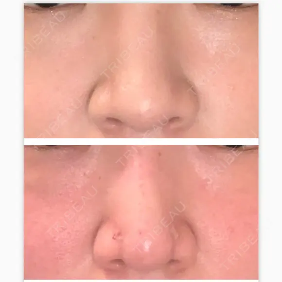 鼻尖形成（切開） / 鼻尖縮小 / ヒアルロン酸注入（鼻） 東京ヒルズクリニック 新宿院 BEFORE メイン用