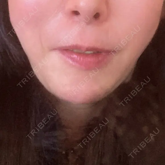 糸リフト 形成外科と美容外科のクリニック池袋 BEFORE メイン用