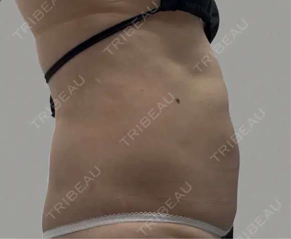 脂肪吸引（お腹） eクリニック 広島院 BEFORE メイン用