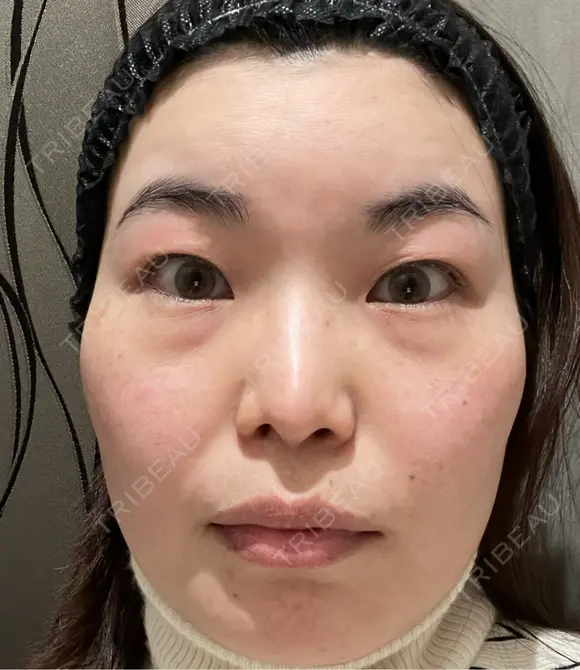 クマ治療 / 下まぶたの脂肪取り 新宿美容外科ネビュラクリニック BEFORE メイン用