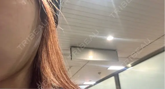 ルメッカ / LDM・インテンスウルトラ Chloe Cheongdam Clinic （クロエチョンダムクリニック） BEFORE メイン用