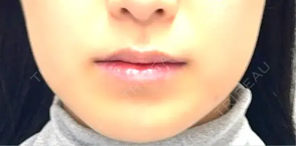 ボトックス（エラ・小顔） BiBiクリニック BEFORE メイン用