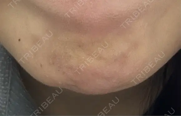 ボトックス（あご） 池袋美容クリニック BEFORE メイン用