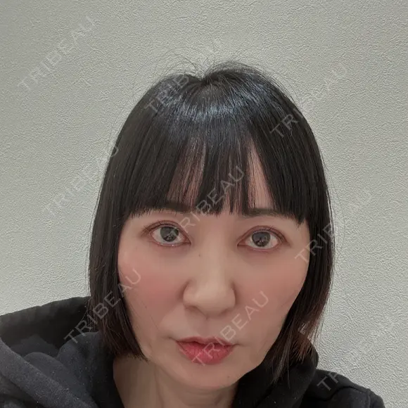 ヒアルロン酸注入（あご） / その他（輪郭） eクリニック 那覇院 BEFORE メイン用