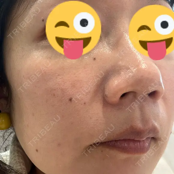 イオン導入 / ピコレーザートーニング（美白・肝斑） ルラ美容クリニック 渋谷本院 BEFORE メイン用