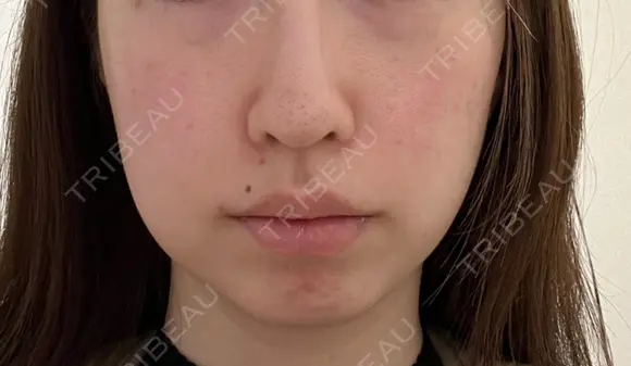 美肌レーザー / シミ取りレーザー / 美白レーザー / エレクトロポレーション / 毛穴洗浄（ハイドラフェイシャルなど） / ピコレーザートーニング（美白・肝斑） / フラクショナルレーザー（毛穴・ニキビ跡） / レーザートーニング（美白・肝斑） Fellez Clinic【フェルズクリニック】 BEFORE メイン用