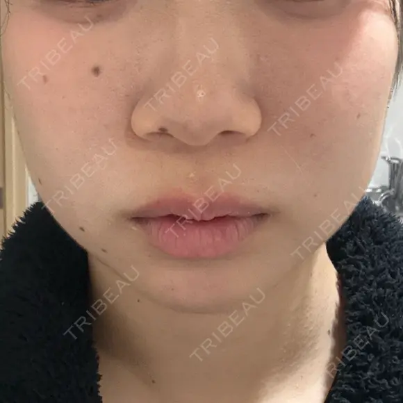 オンダリフト Ledian Clinic六本木 BEFORE メイン用