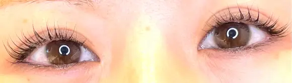 目尻切開 / タレ目形成・グラマラスライン（埋没） LOUIS CLINIC 二子玉川院【ルイクリニック】 BEFORE メイン用