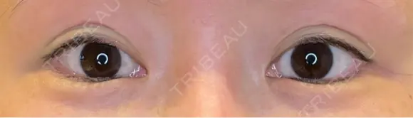 目尻切開 / タレ目形成・グラマラスライン（埋没） LOUIS CLINIC 二子玉川院【ルイクリニック】 BEFORE メイン用