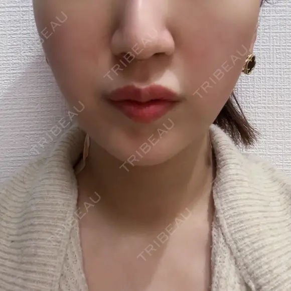 インモード BISIN GINZA CLINIC BEFORE メイン用