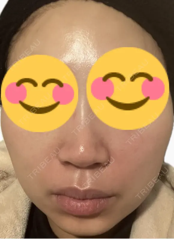 脂肪溶解注射（顔） 上野注入クリニック BEFORE メイン用