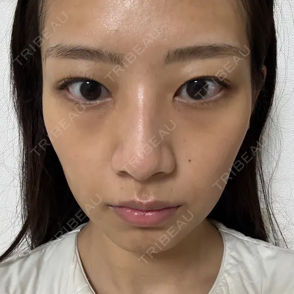 イオン導入 城本クリニック 大阪院 BEFORE メイン用