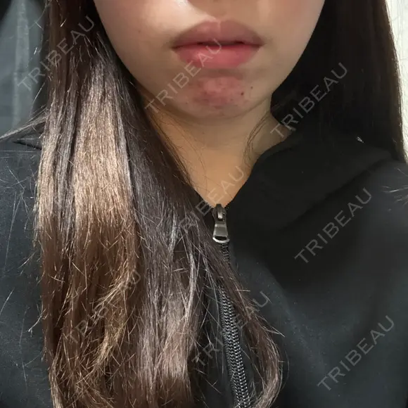 その他（肌） / RF（高周波）たるみ治療 / オンダリフト / その他（輪郭） ライブリークリニック 浜松町院 BEFORE メイン用