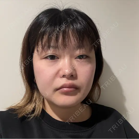 糸リフト / 脂肪吸引（顔） / ボトックス（エラ・小顔） 新宿美容外科ネビュラクリニック BEFORE メイン用