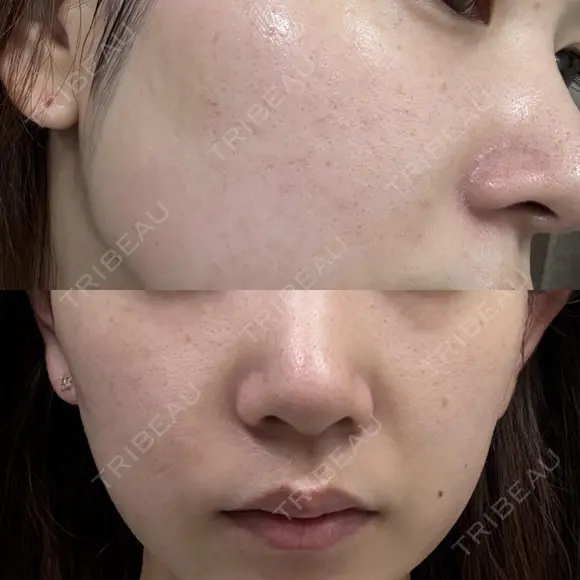 イオン導入 / 毛穴洗浄（ハイドラフェイシャルなど） / ルメッカ ルラ美容クリニック 岡山院 BEFORE メイン用