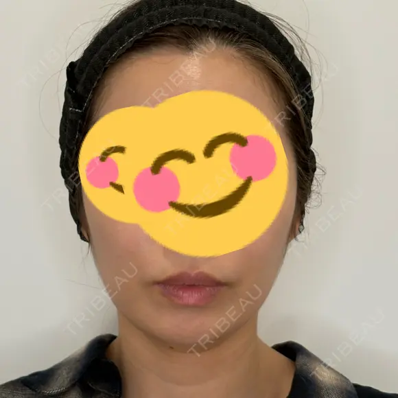 糸リフト / ボトックス（エラ・小顔） Olivia Clinic BEFORE メイン用