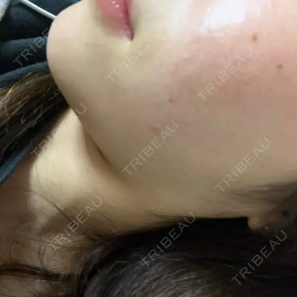 ピーリング（ニキビ・毛穴） / イオン導入 / LED治療 東京素肌クリニック 新宿院 BEFORE メイン用