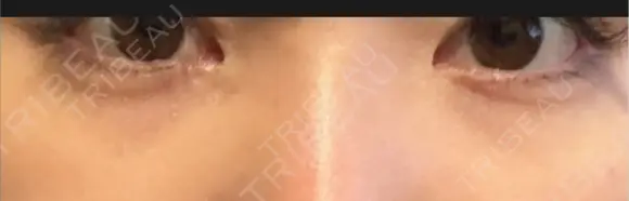 ベビーコラーゲン AI Beauty Clinic （エーアイ美容クリニック） BEFORE メイン用