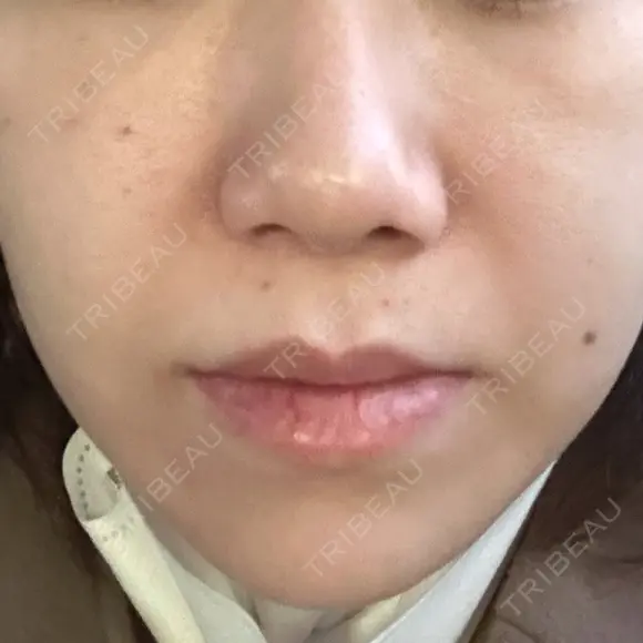 ルメッカ ルラ美容クリニック 郡山院 BEFORE メイン用