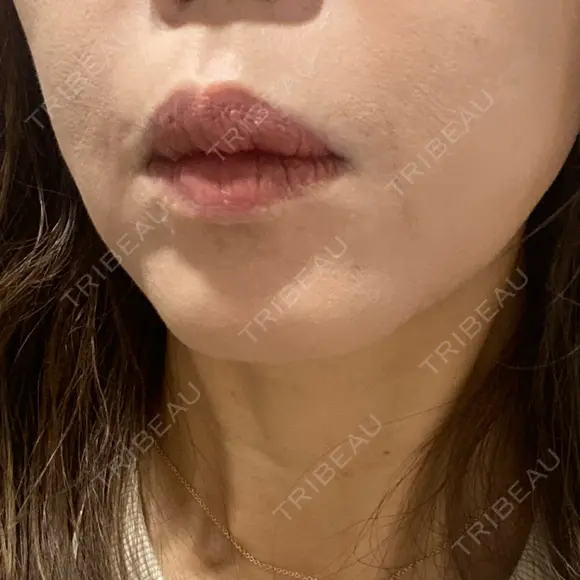 ボトックス（人中） / 医療脱毛（ワキ） 湘南美容クリニック 新橋銀座口院 BEFORE メイン用