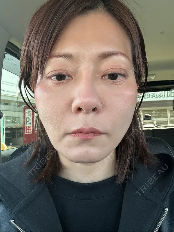 糸リフト 小倉美容外科/美容皮膚科 ビラビューティークリニック BEFORE メイン用