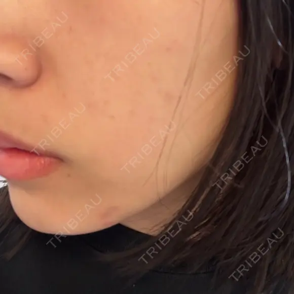 光治療（フォトフェイシャルなど） アクティブエイジクリニック BEFORE メイン用