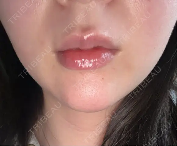 ヒアルロン酸注入（あご） / ボトックス（エラ・小顔） / インモード ルラ美容クリニック 新潟院 BEFORE メイン用