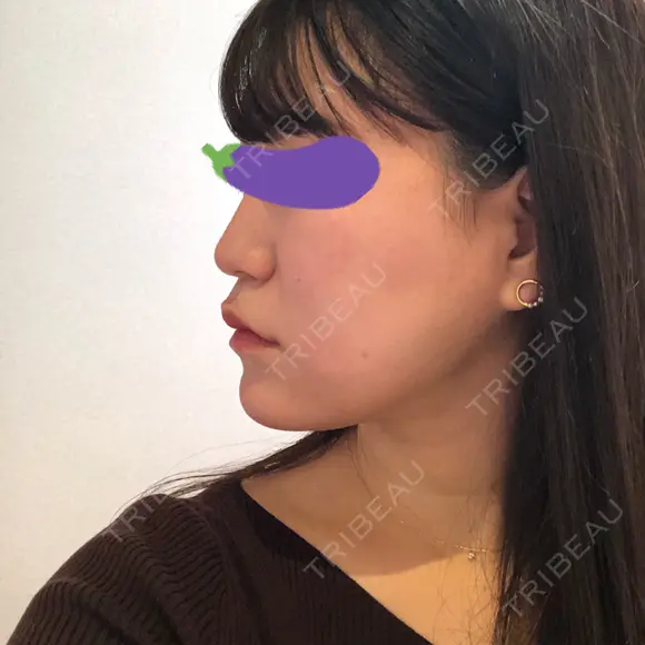 スレッドノーズ Beauty Clinic the GINZA BEFORE メイン用