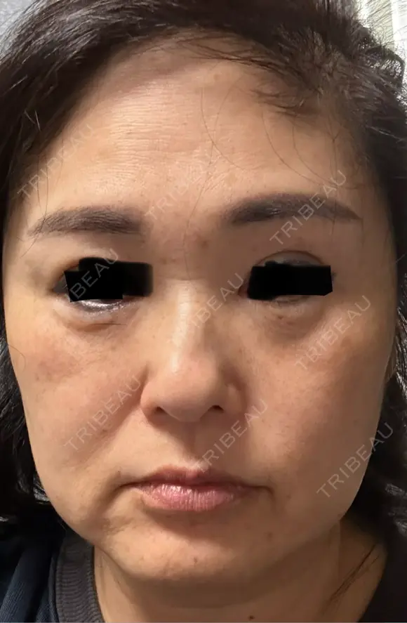 クマ治療 ROOTS Clinic BEFORE メイン用