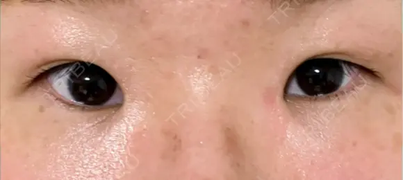 二重切開 / 目頭切開 EMMA CLINIC（エマクリニック） BEFORE メイン用