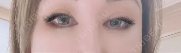 眼瞼下垂（切開） / クマ治療 / 目尻切開 / 下まぶたたるみ取り / 下まぶたの脂肪取り / タレ目形成・グラマラスライン（切開） / 眉下切開 id（アイディ）美容外科 BEFORE メイン用
