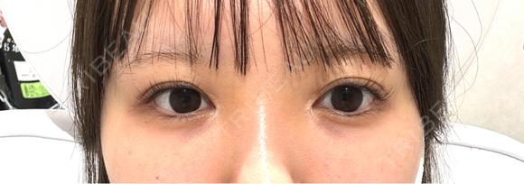 ヒアルロン酸注入（涙袋） / ヒアルロン酸注入（唇） ziz CLINIC BEFORE メイン用
