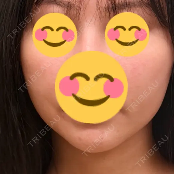 エレクトロポレーション / RF（高周波）たるみ治療 Days Beauty Clinic 新宿院 BEFORE メイン用