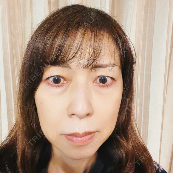 インモード / オンダリフト RIVER CLINIC（リバークリニック） BEFORE メイン用