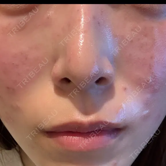 ピコスポット G MEDICAL ART クリニック 新宿院 BEFORE メイン用