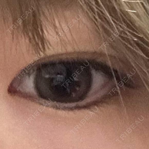 二重埋没 ASTRA BEAUTY CLINIC BEFORE メイン用