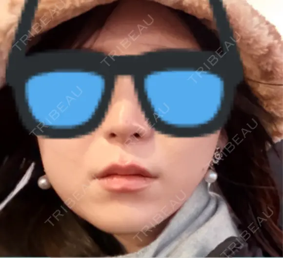オリジオ Chloe Cheongdam Clinic （クロエチョンダムクリニック） BEFORE メイン用