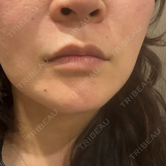 ハイフ（顔） Natural Skin Clinic 自由ヶ丘院 BEFORE メイン用