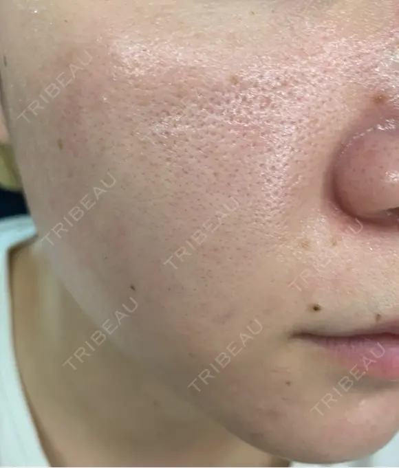 水光注射（ハリ・美肌） エトワールレジーナクリニック新宿院 BEFORE メイン用