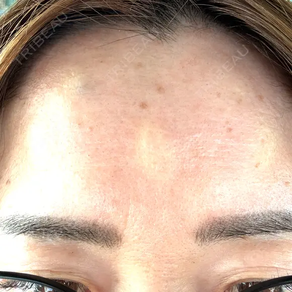 ボトックス（額） ルラ美容クリニック 郡山院 BEFORE メイン用