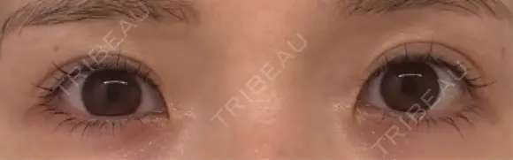 目頭切開 / ヒアルロン酸注入（涙袋） / ボトックス（あご） / ベビーコラーゲン AI Beauty Clinic （エーアイ美容クリニック） BEFORE メイン用