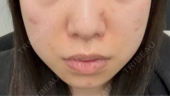 ピコスポット G MEDICAL ART クリニック 新宿院 BEFORE メイン用