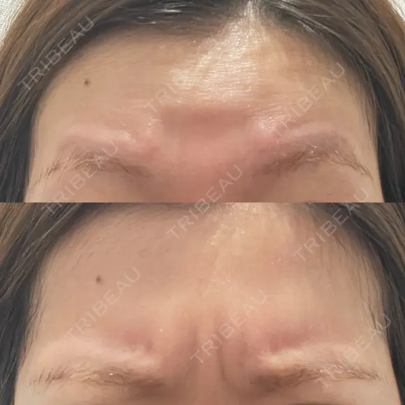 ワキ汗治療（ボトックス） / ボトックス（眉間） J CLINIC BEFORE メイン用