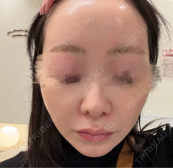 ピコレーザートーニング（美白・肝斑） / LDM・インテンスウルトラ Chloe Cheongdam Clinic （クロエチョンダムクリニック） BEFORE メイン用