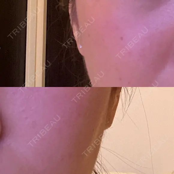 ハイフ（顔） / デンシティ DAILY SKIN CLINIC 新宿院 BEFORE メイン用