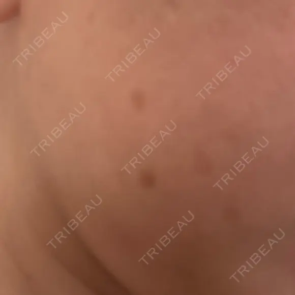 ピーリング（ハリ・ツヤ） / ルメッカ 小倉美容外科/美容皮膚科 ビラビューティークリニック BEFORE メイン用